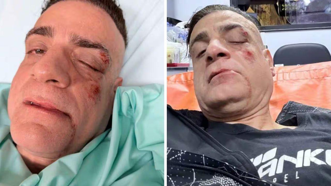 Simone Cicalone dopo l'aggressione (Foto da Ig: simonecicalone)