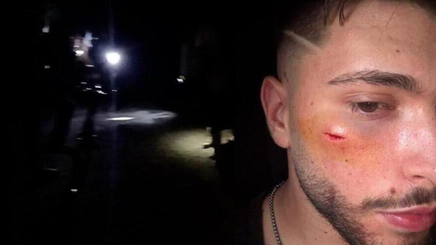 Leonardo Pistoia dopo l’aggressione denunciata nei mesi scorsi