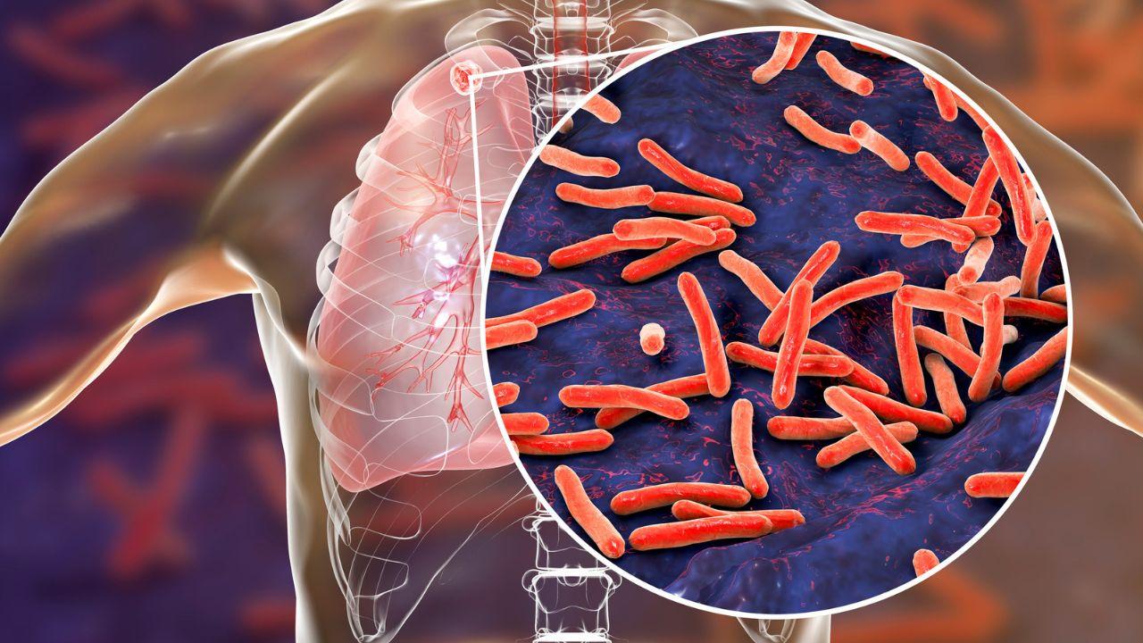 Grosseto, caso di tubercolosi a scuola. L’Asl: «Non ci sono rischi rilevanti di contagio»
