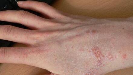 «Caso scabbia, un dovere la trasparenza sulla sanità»