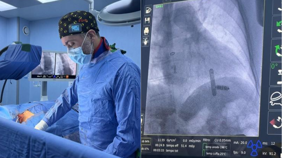 Cardiologia, primo impianto di pacemaker senza fili per via giugulare in Sardegna: «Più rapido e sicuro» – ecco dove