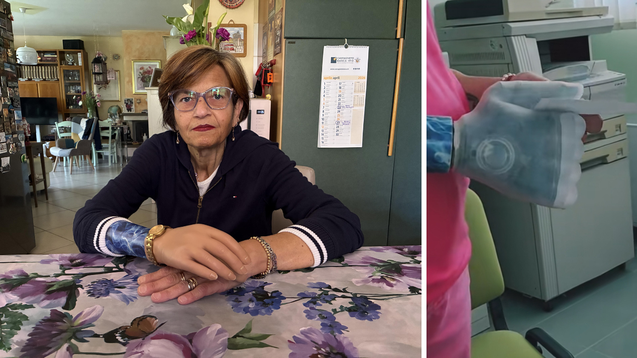 Cinzia D'Amicis e a destra la tanto sognata mano bionica