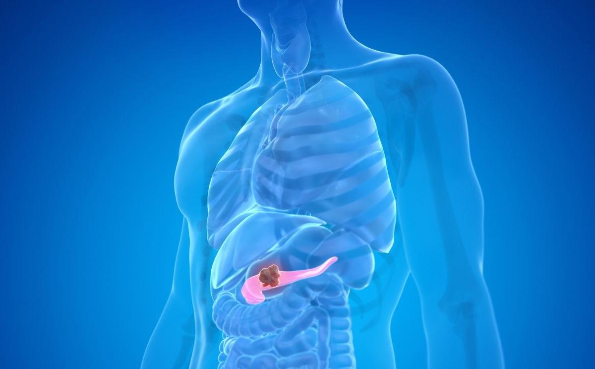 
	Tumore al pancreas: uno studio con Unimore apre nuove prospettive per terapie mirate

