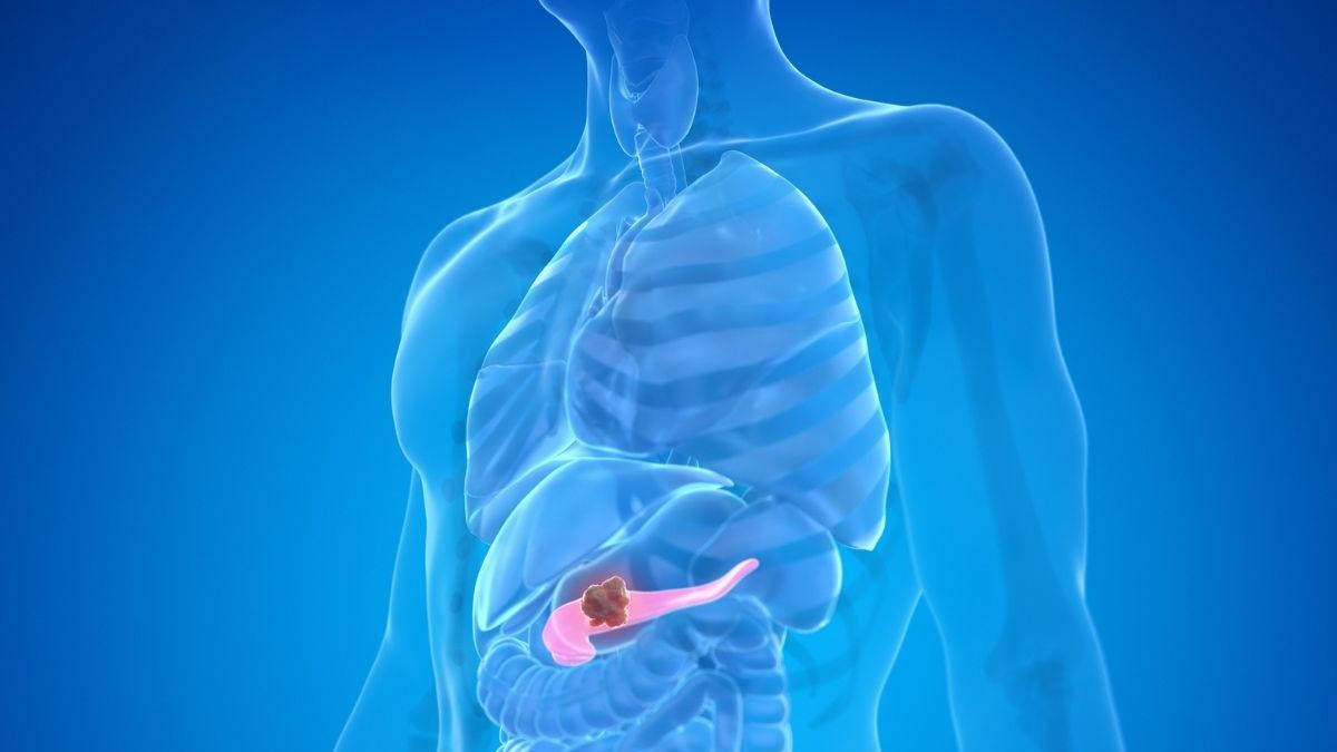 Tumore al pancreas: uno studio con Unimore apre nuove prospettive per terapie mirate