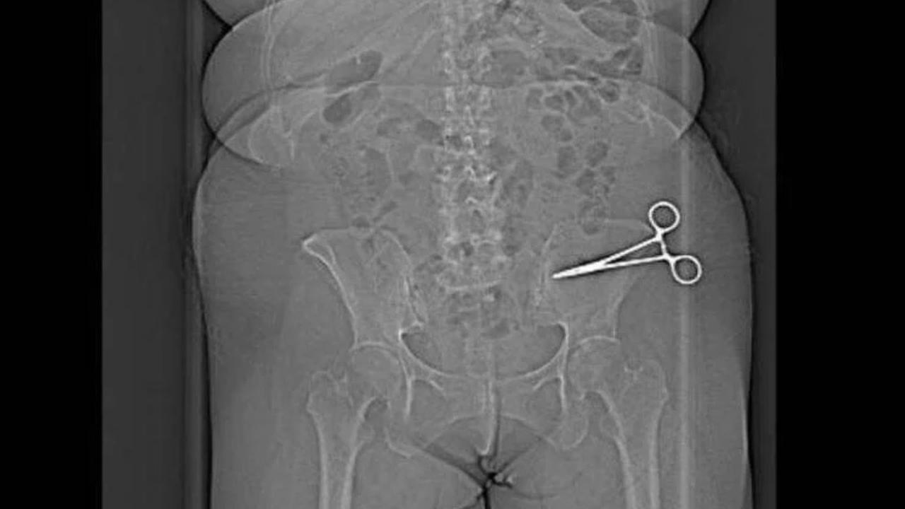 Chirurgo dimentica le forbici nel corpo della paziente: la scoperta dopo sette mesi di dolori atroci
