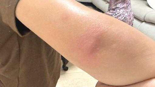L’asilo invaso dalle zanzare, decine di bambini punti: i genitori diffidano il Comune