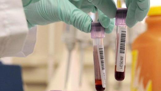 Un caso di epatite A, scatta la profilassi