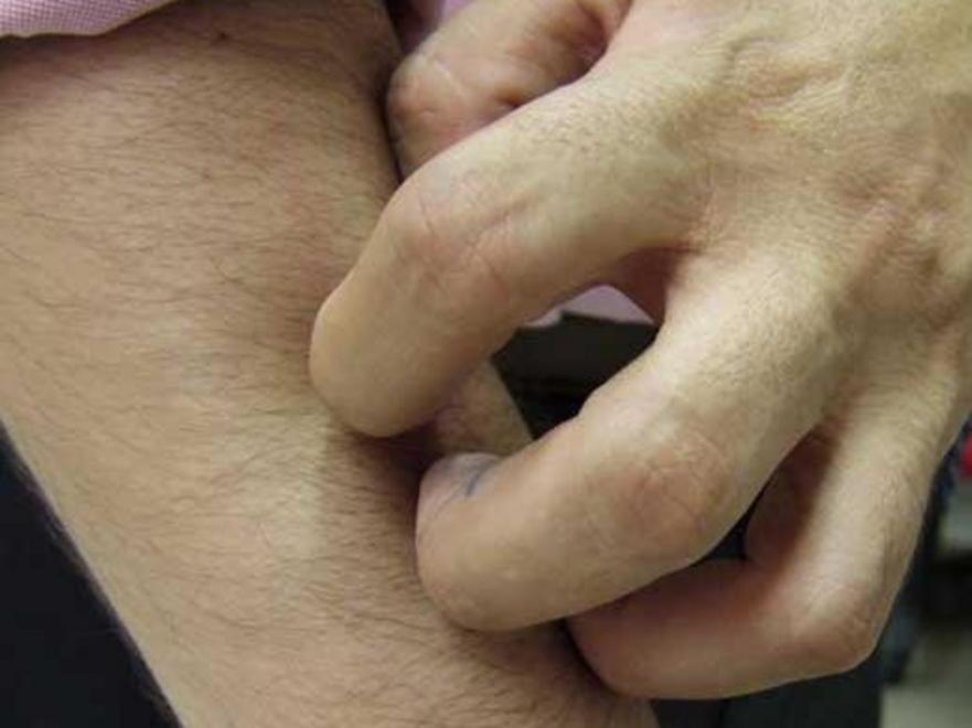 Una forma rara e aggressiva 