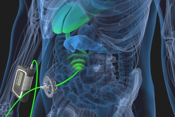 Diabetici con lipodistrofia, ospedale all’avanguardia 