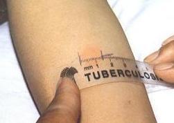 Tubercolosi, tre bambini in ospedale 