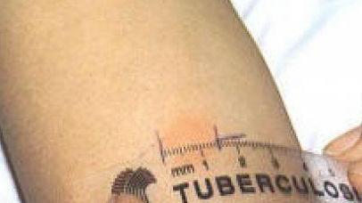 Frequenta un nido in città la bimba di 2 anni colpita da tubercolosi