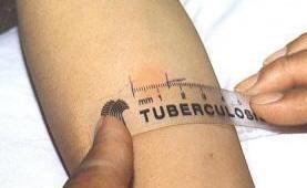 Tubercolosi, screening per 19 alunni 