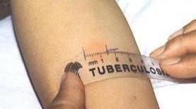 Tubercolosi, screening per 19 alunni