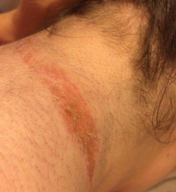 Sciarpa incastrata nella moto ferita al collo una ventenne