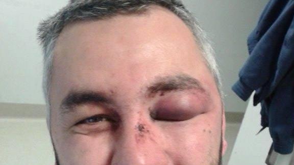 Elio Marracci con l'occhio tumefatto e il naso fratturato nella foto che lui stesso ha postato du Facebook