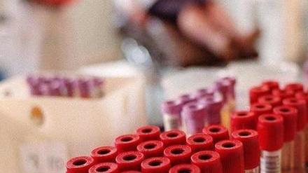 L’Aids fa ancora paura: a Cisanello seguiti 1.200 casi