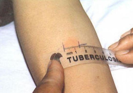 Tubercolosi a scuola Positivi otto alunni