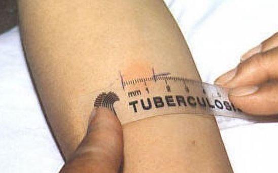 Tubercolosi a scuola positivi otto alunni 