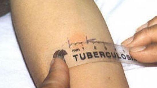 Tubercolosi a scuola positivi otto alunni