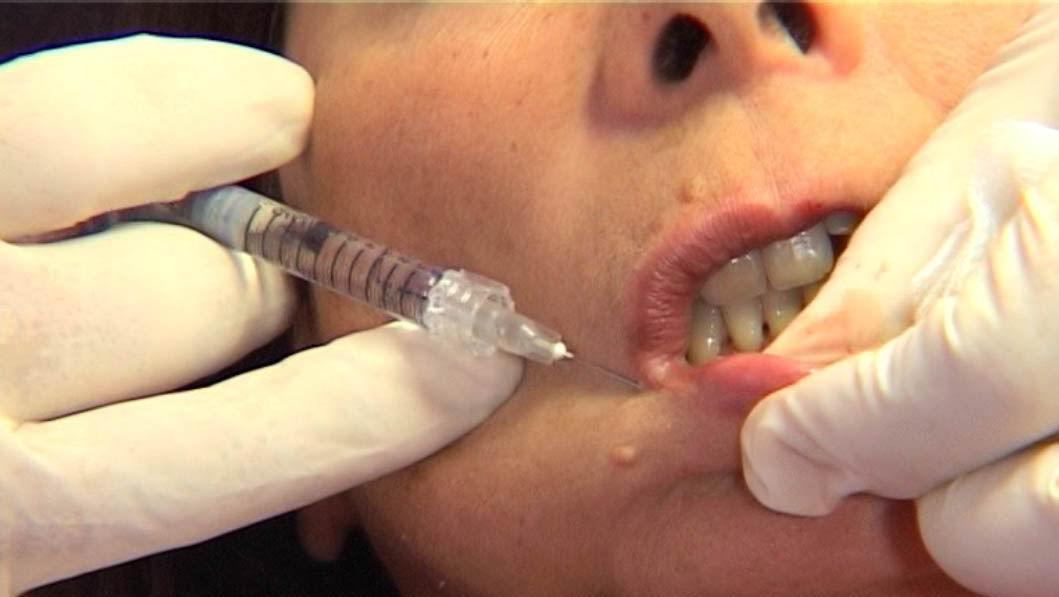 Viso deturpato dopo la cura estetica. Medico a processo 