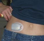 Bambini e diabete: ecco il “cerotto” per i test