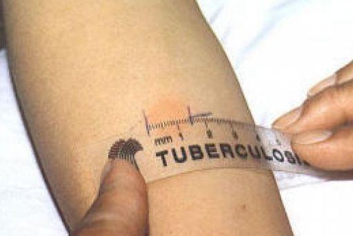 Pietrasanta, caso di tubercolosi in una scuola media 
