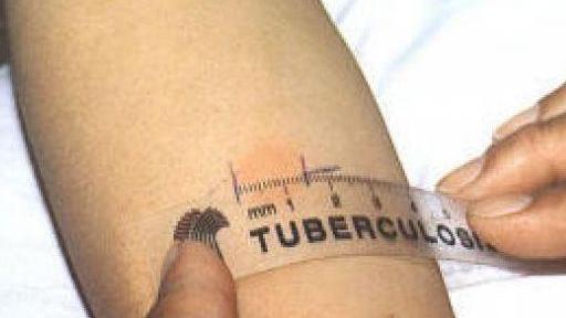 Pietrasanta, caso di tubercolosi in una scuola media