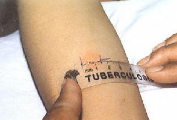 Un test per verificare la presenza di tubercolosi (archivio)