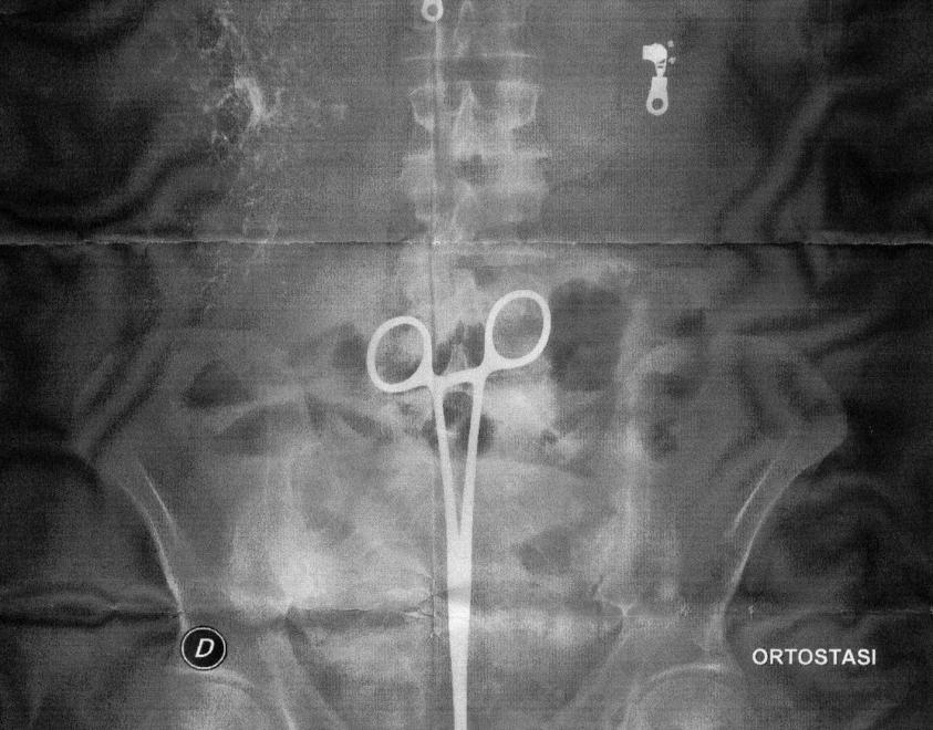 Morto l’uomo che aveva la pinza nello stomaco