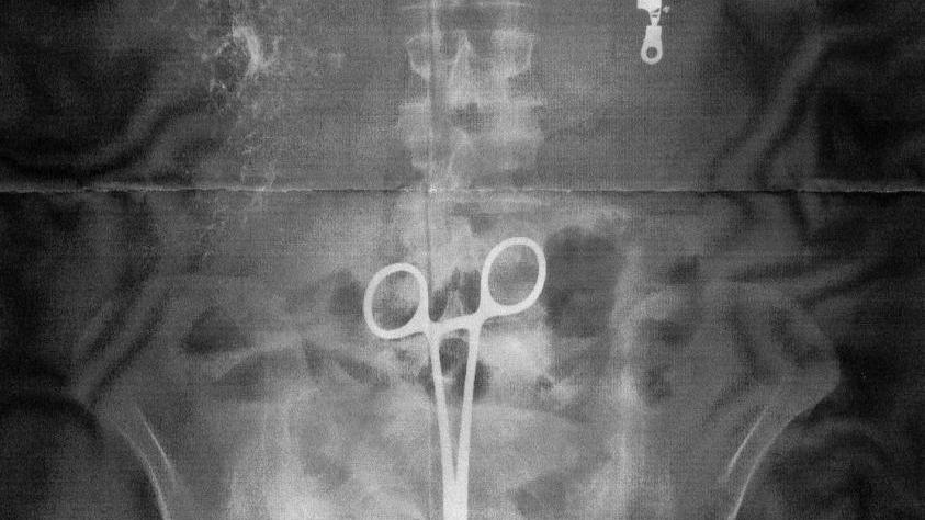 Morto l’uomo che aveva la pinza nello stomaco