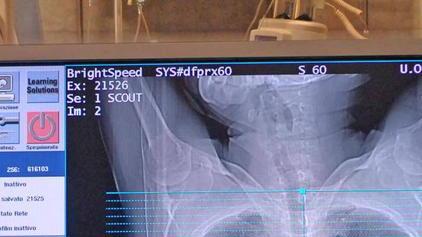 Stop alla radiologia fino a settembre