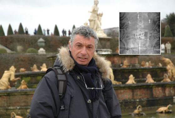 Stefano Miniati e la pinza dimenticata