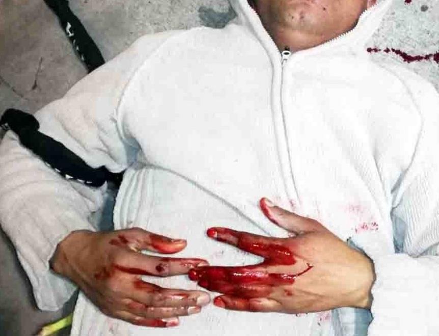 Picchiato con pugni, calci e una catena, è in prognosi riservata al S.Anna