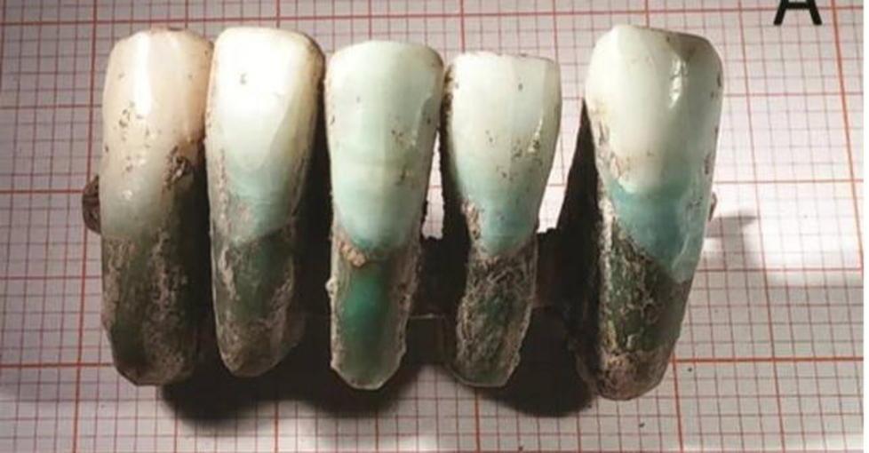 Tra i resti dei Guinigi una protesi di 4 secoli fa 