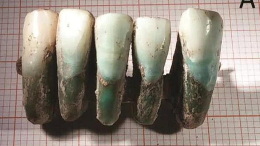 Tra i resti dei Guinigi una protesi di 4 secoli fa