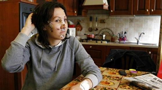 Giada Norfini, sfregiata dall'ex con una bottiglia