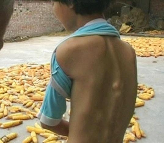 Una foto simbolo degli effetti della fibrodisplasia ossificante