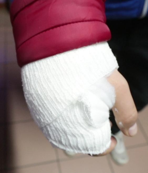 La mano ferita con un colpo di spranga