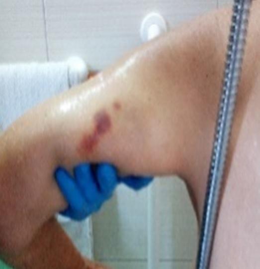 I segni dei maltrattamenti sul braccio di un ospite di Villa Rosina