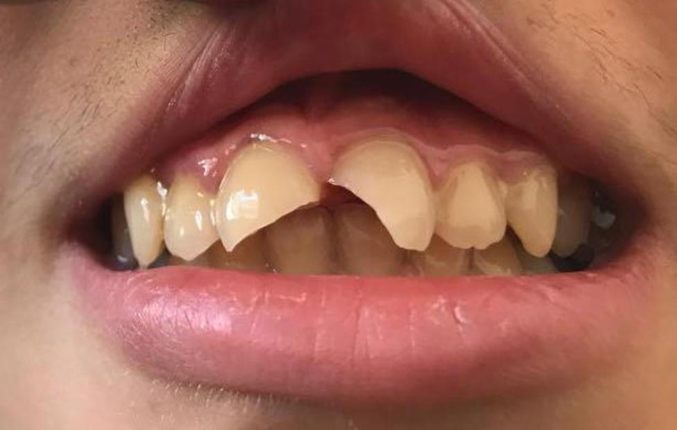 Violenza a scuola, spacca i denti al compagno davanti alla professoressa 