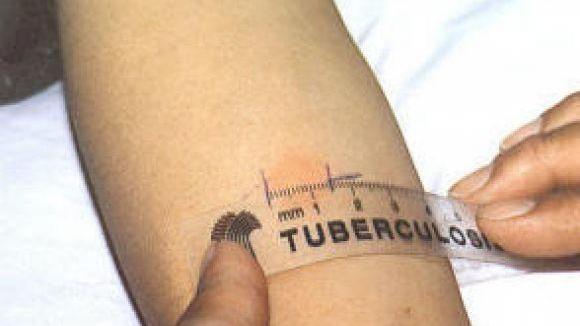 Un medico è accusato di aver prescritto un farmaco che ha riattivato la Tbc in un paziente