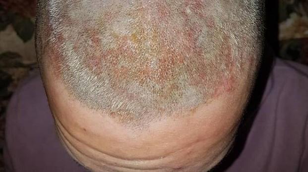 La testa della ragazza ustionata