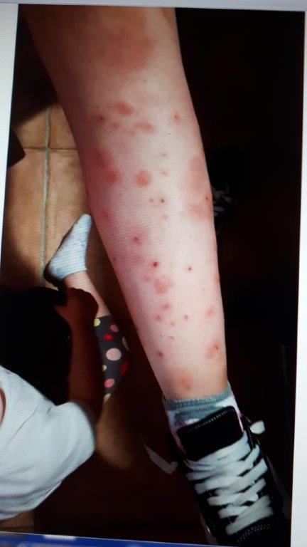 Una ragazzina è ricorsa alle cure dei medici per le punture di zanzara