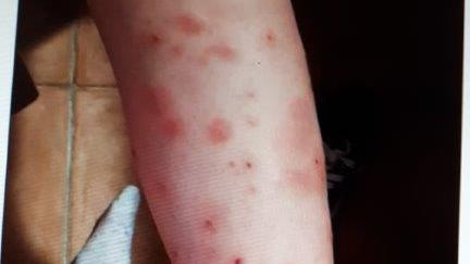 Una ragazzina è ricorsa alle cure dei medici per le punture di zanzara