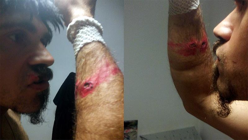 L'ingegnere Domenico Sanna mostra la ferita al braccio