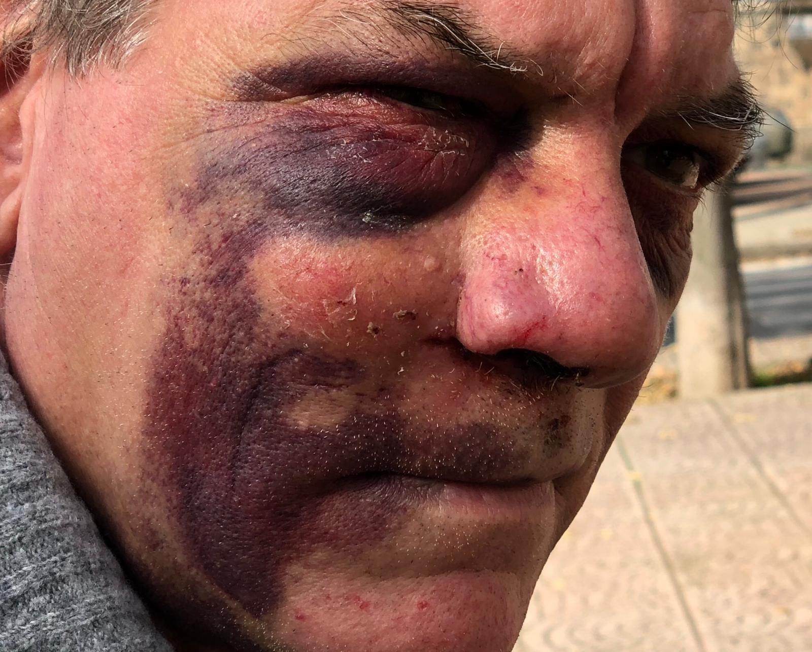 Le ferite al volto riportate dall'uomo rapinato a Sassari