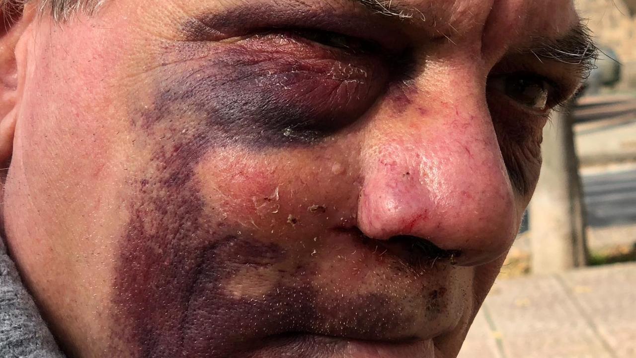 Le ferite al volto riportate dall'uomo rapinato a Sassari