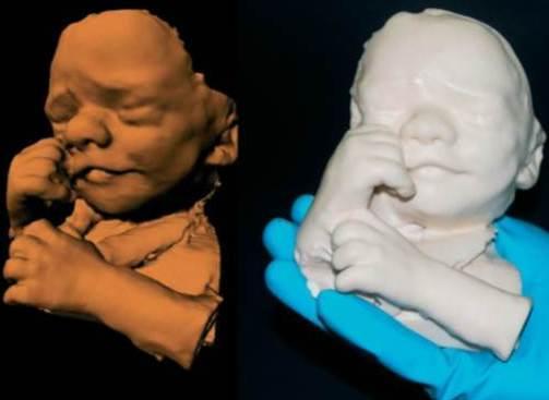 La ricostruzione 3D di un feto e il modello in resina