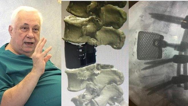 Il professor Rodolfo Capanna e un'immagine della vertebra sostituita