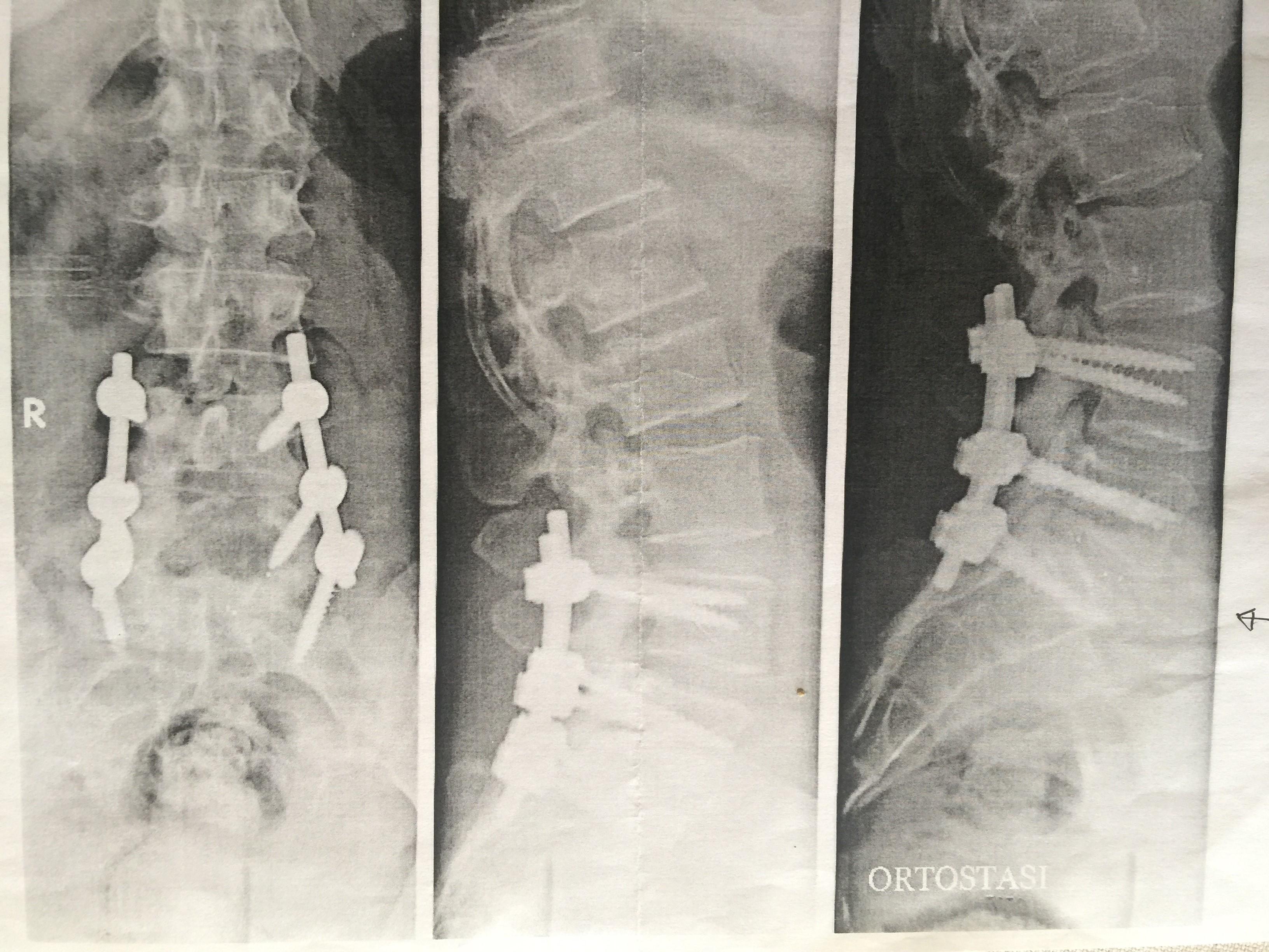 Le viti poste nella colonna della donna che secondo l'accusa sarebbero la causa della sua attuale invalidità